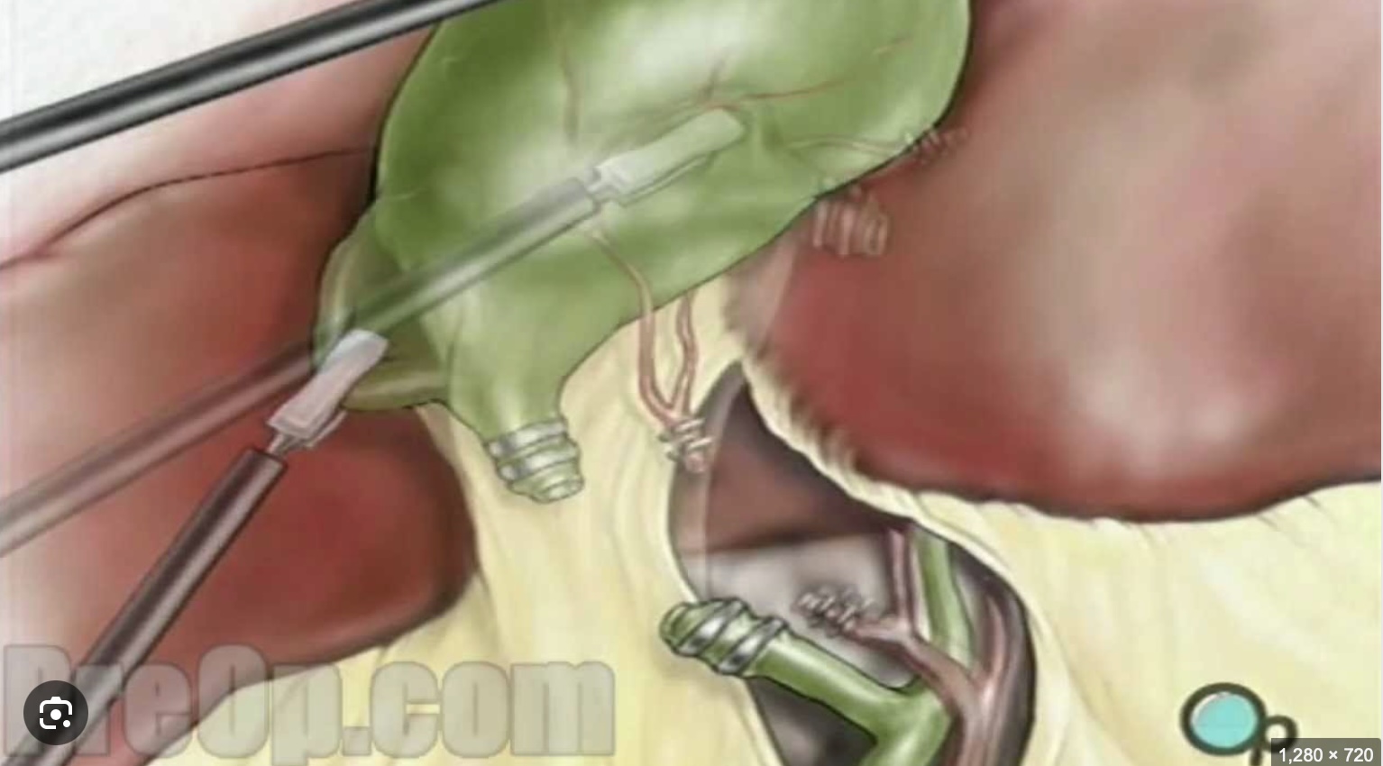 Gallbladder Surgery